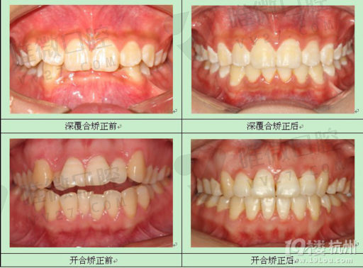 装假牙和种植牙的价格区别是什么,问题锦集(图1)